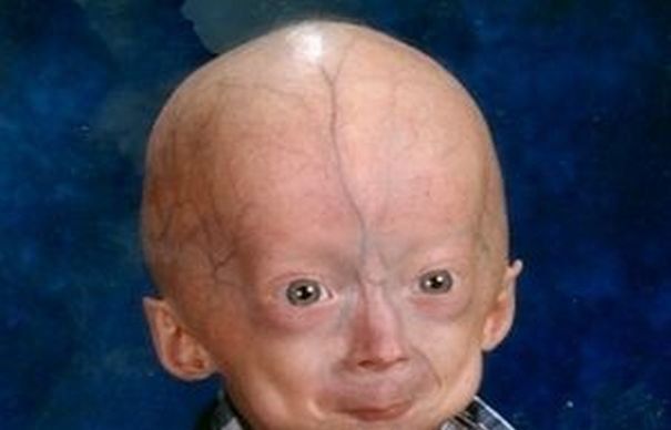 Progeria, BOALA RARA care TRANSFORMA COPIII IN MONSTRI. Imagini socante si DESTINE FRANTE l Foto galeria durerii